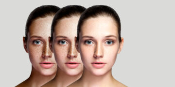 다크스팟,기미 완화에 좋은 독일과 유럽의 대표 미백 화장품 추천